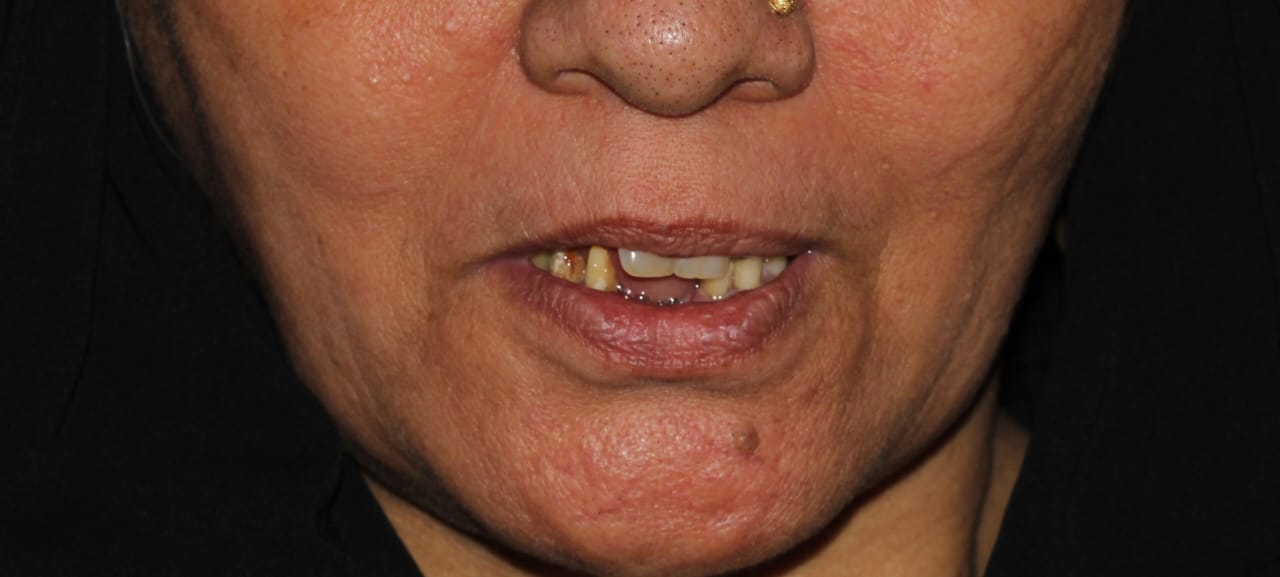Full mouth rehabilitation, before treatment
