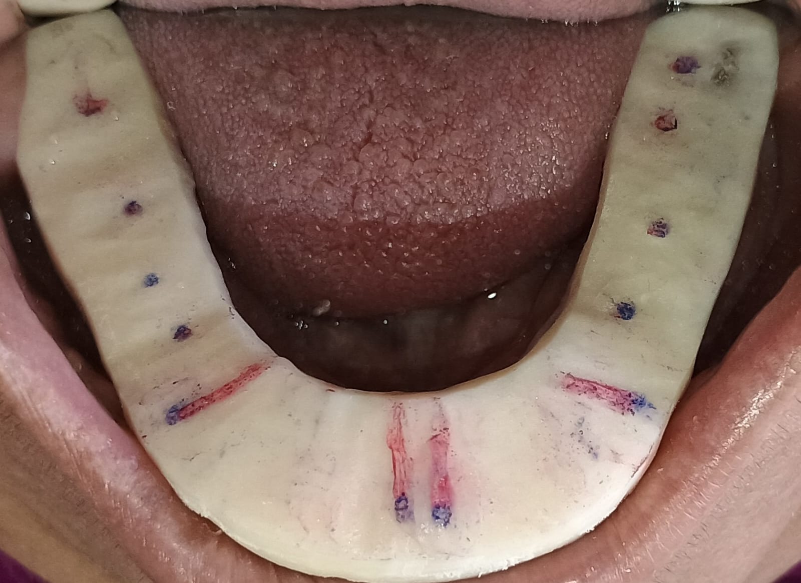 CR splint case