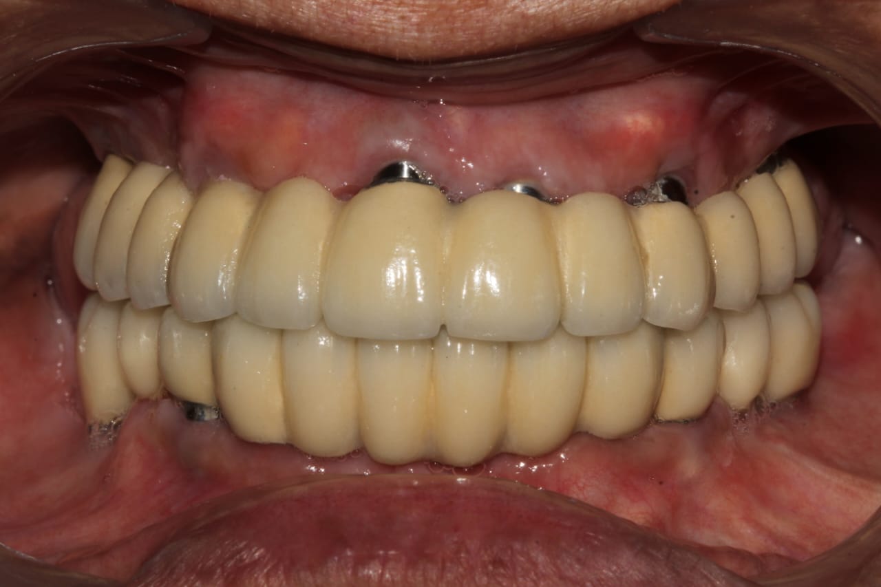 Full mouth implant rehabilitation, after treatment
