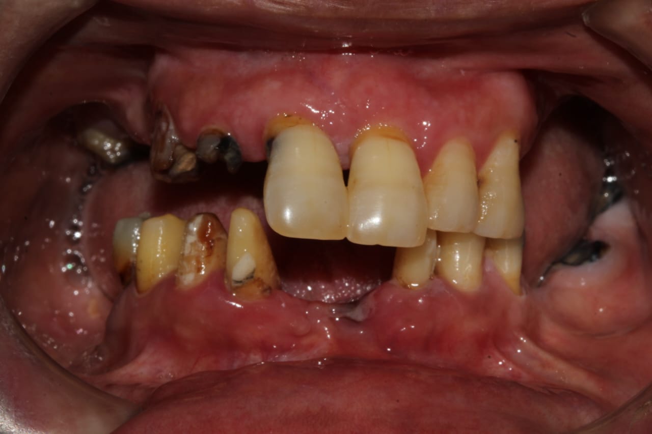Full mouth implant rehabilitation, before treatment